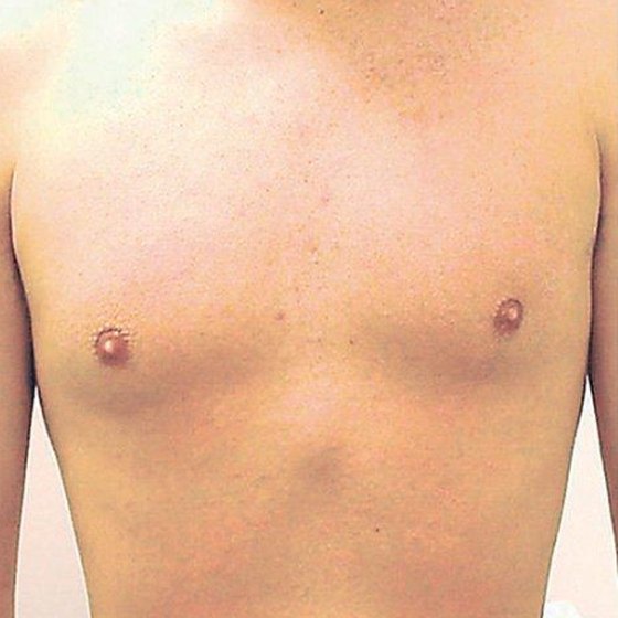 Chest after